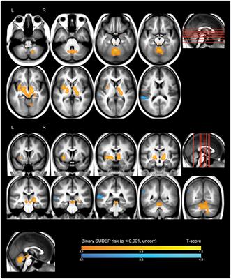 Distinct Patterns of Brain Metabolism in Patients at Risk of Sudden Unexpected Death in Epilepsy